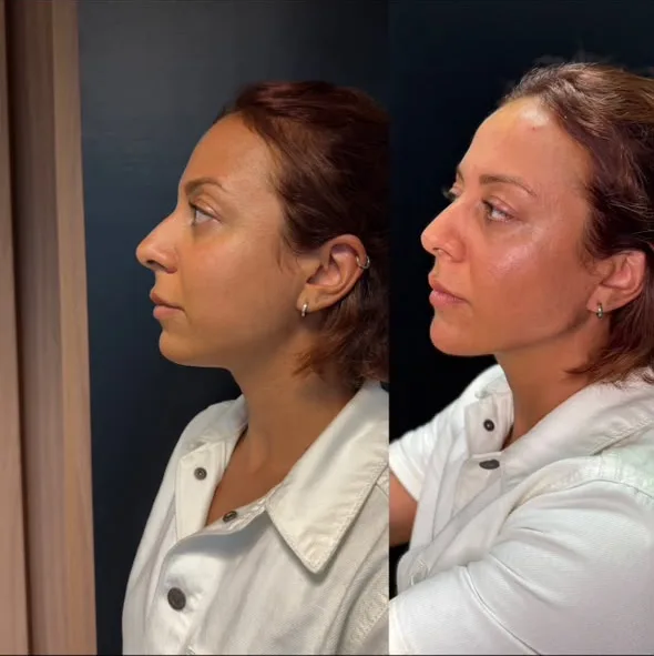 Caso real de estruturação facial em vista de perfil: antes, à esquerda, e depois, à direita